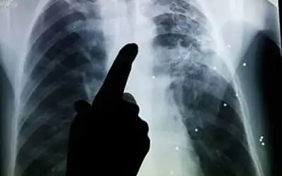 TB Cases Rise in Balochistan as Screening in Prisons Detects New Infections
