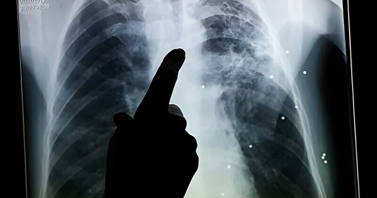 TB Cases Rise in Balochistan as Screening in Prisons Detects New Infections