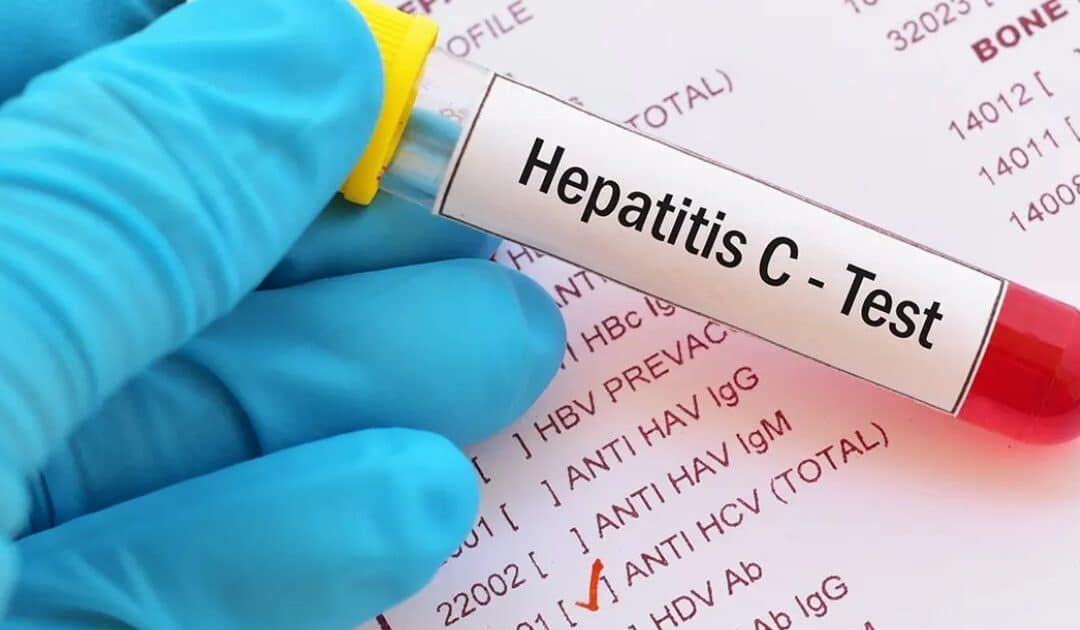 PMA sounds alarm on World Liver Day as Pakistan faces world’s highest Hepatitis C burden