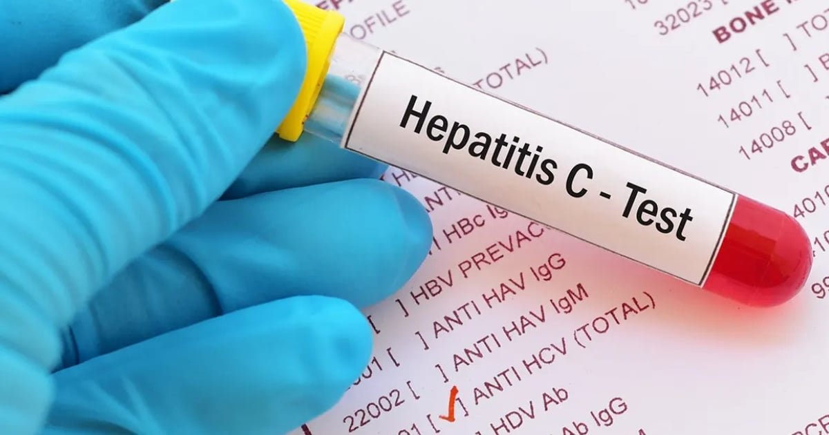 PMA sounds alarm on World Liver Day as Pakistan faces world's highest Hepatitis C burden